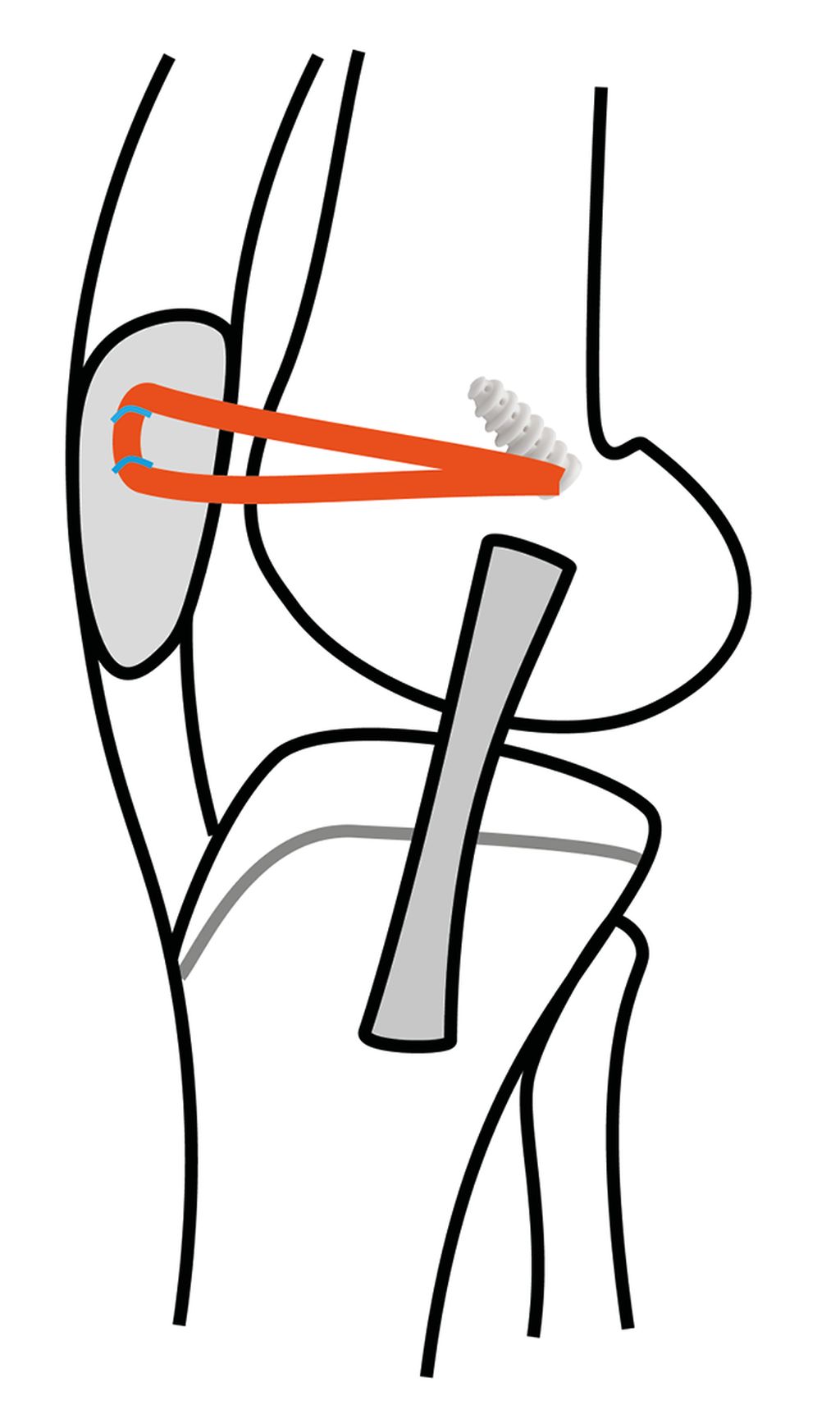 MPFL-Rekonstruktion: Working Horse der Patellainstabilitätschirurgie ...