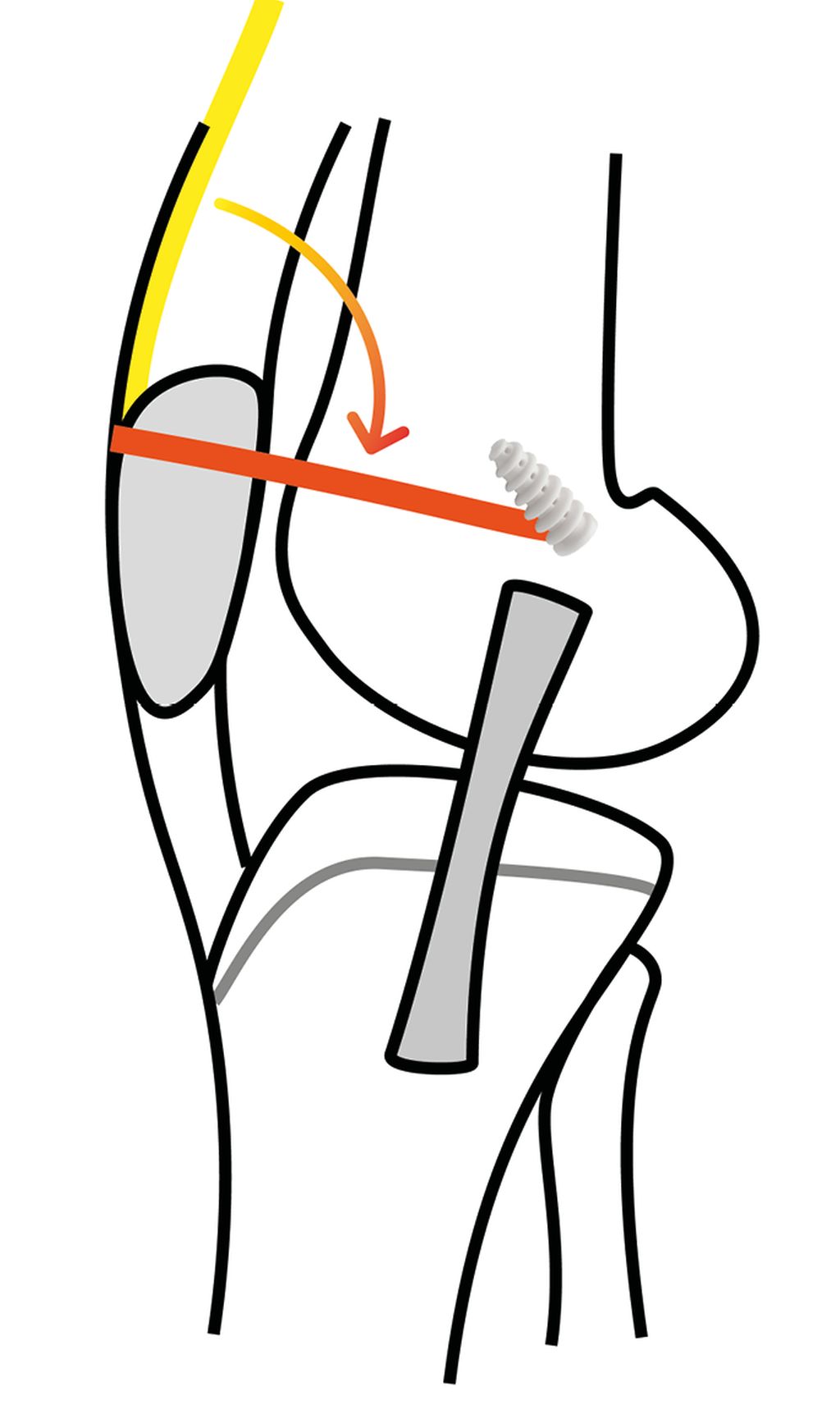 MPFL-Rekonstruktion: Working Horse der Patellainstabilitätschirurgie ...