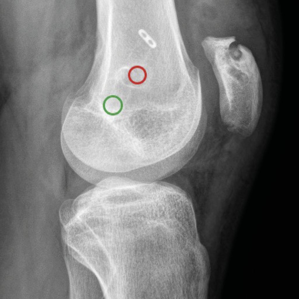 MPFL-Rekonstruktion: Working Horse der Patellainstabilitätschirurgie ...