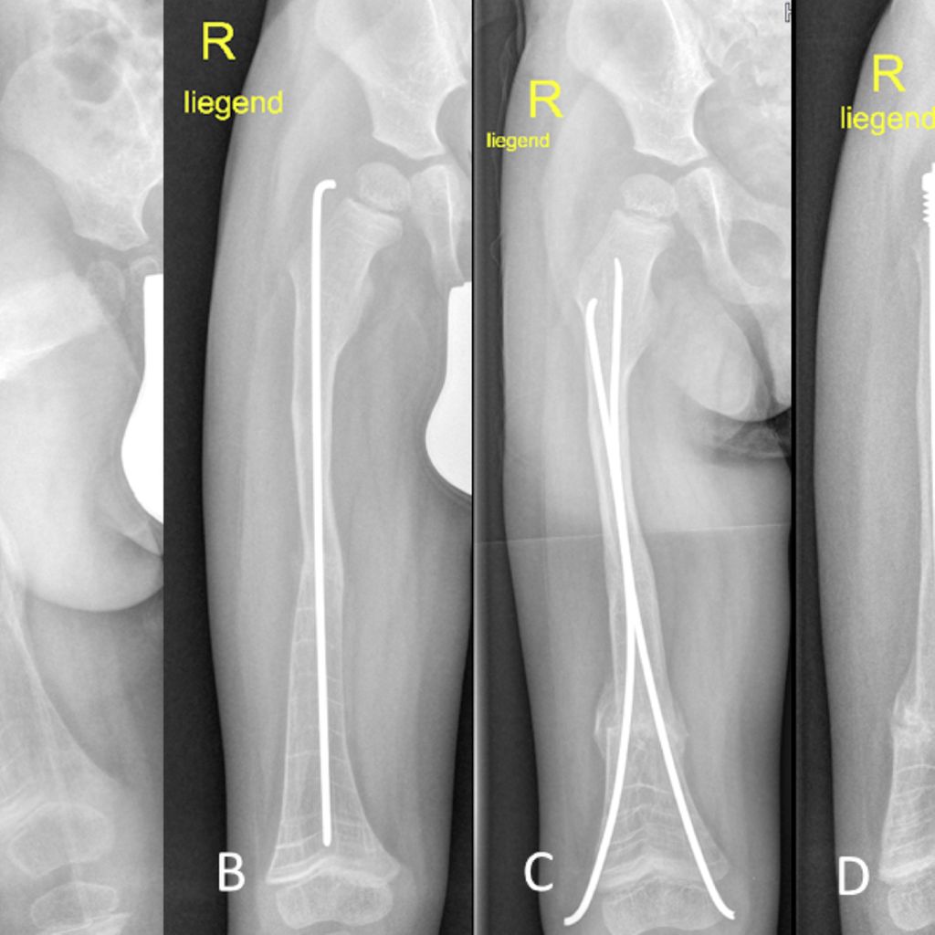 Osteogenesis Imperfecta Und Andere Seltene Erkrankungen Mit Frakturris